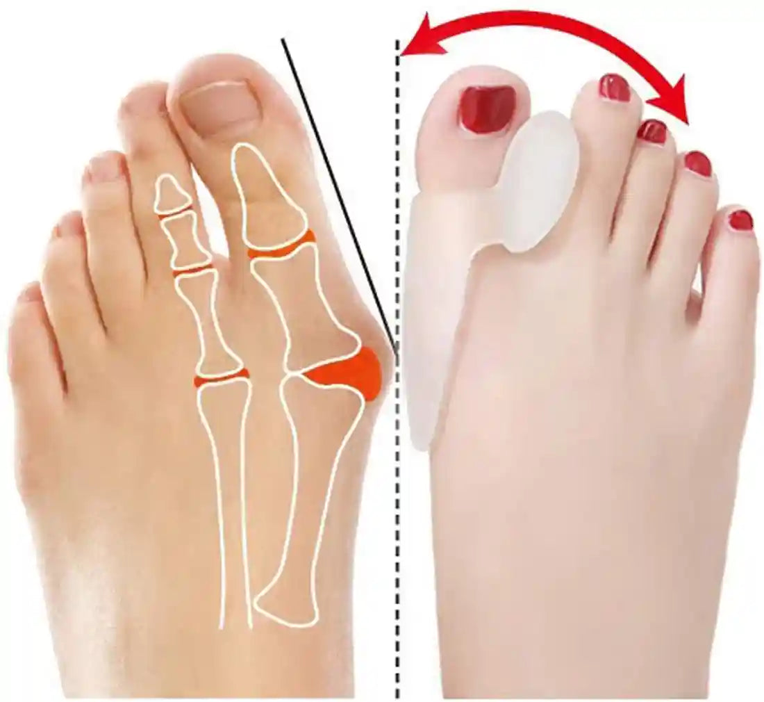 فواصل أصابع سيليكون من زنوورلد – 2 قطعة لتخفيف آلام القدم وتصحيح انحراف الإبهام